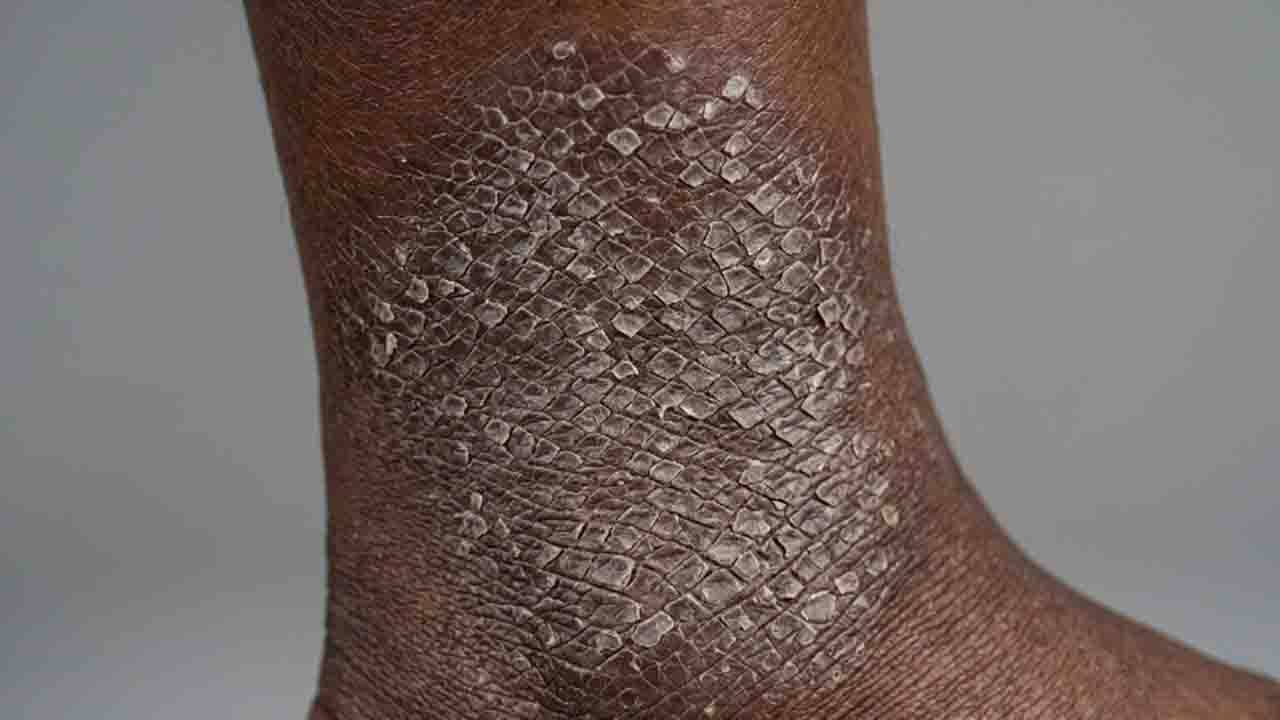 Understanding Ichthyosis The Skin Condition Often Mistaken for Dry Skin